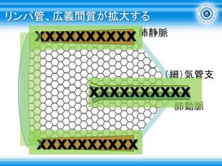 12リンパ管、広義間質が拡大する.jpg