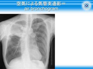 13空気による気管支造影=air bronchogram.jpg