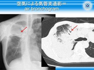 14空気による気管支造影=air bronchogram.jpg