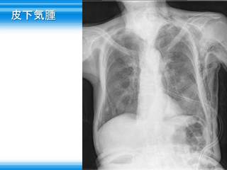 19皮下気腫.jpg