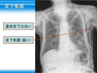 20皮下気腫.jpg