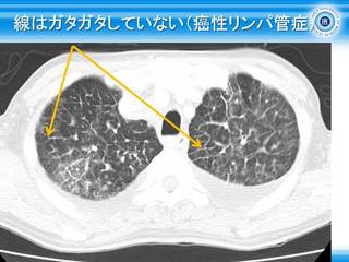 21線はガタガタしていない(癌性リンパ管症).jpg