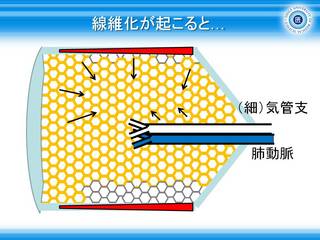 21線維化が起こると….jpg