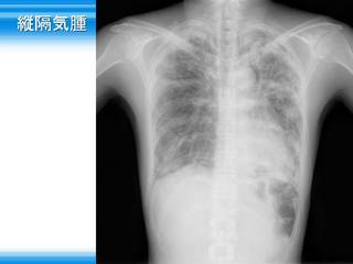 21縦隔気腫.jpg