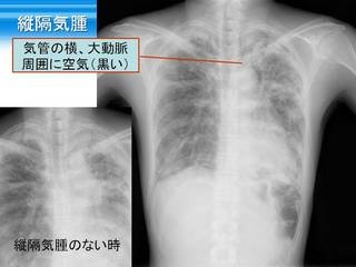 22縦隔気腫.jpg