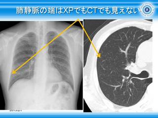 23肺静脈の端はXPでもCTでも見えない.jpg