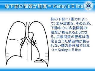 25肺下部の間質が肥厚= Kerley’s B line.jpg