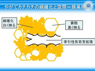 26やがてカチカチの線維化と空間=蜂巣肺に.jpg