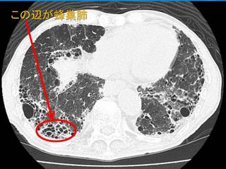 27蜂巣肺.jpg