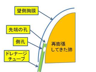 3膨張した肺が孔をふさぐ.JPG