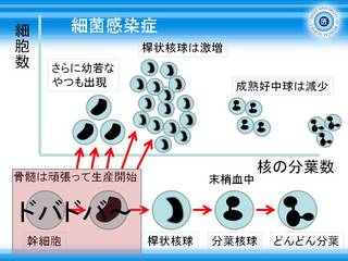 4細菌感染症における好中球の分画.JPG