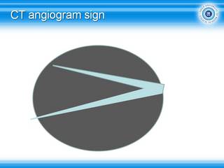 57CT-angiogram sign.jpg