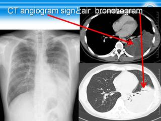 59CT angiogram signair  bronchogram.jpg