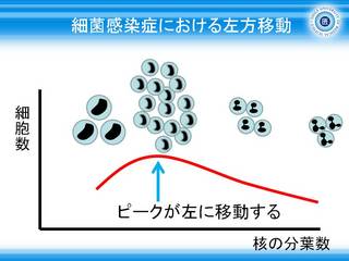 6細菌感染症における好中球の分画グラフ_左方移動.JPG