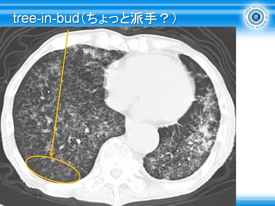 CTパターンから理解する呼吸器疾患 所見×患者情報から導く鑑別と治療+