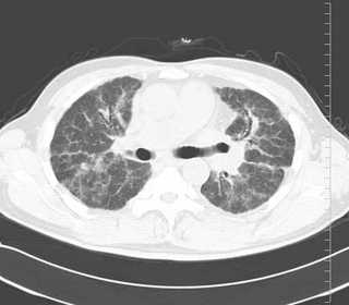 CT肺野条件.jpg