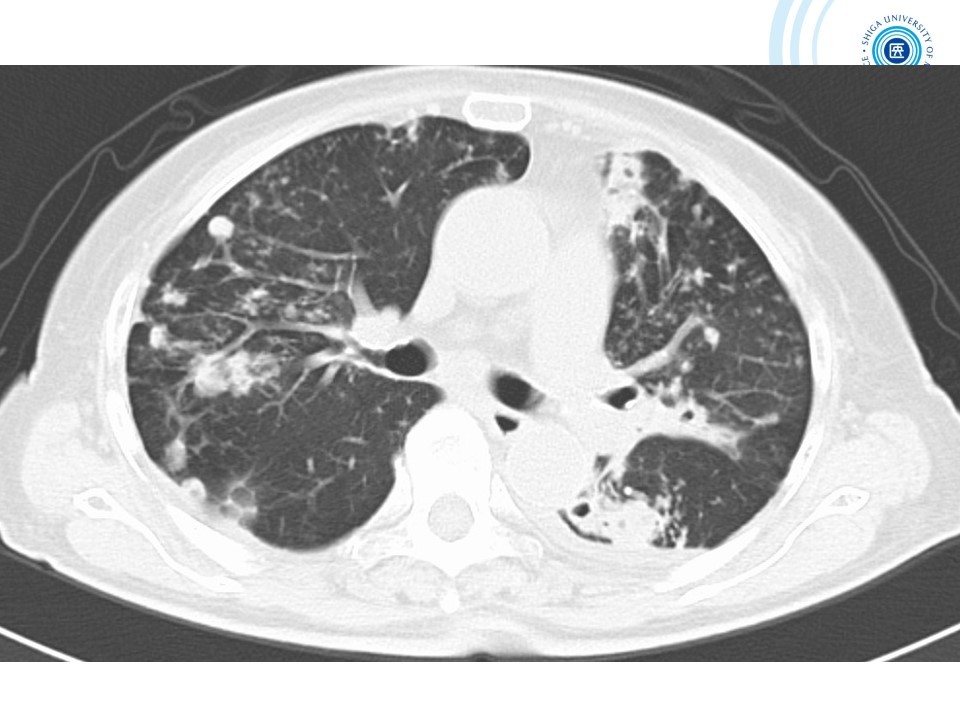 胸部CTの適応と基本的読影4: やさしイイ呼吸器教室