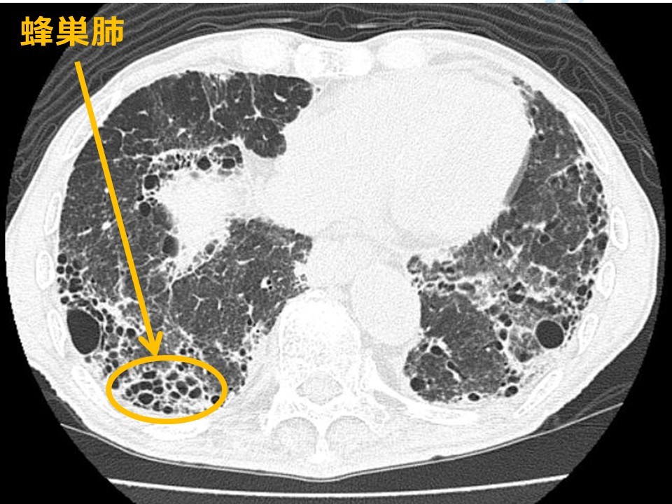 [A01460213]特発性肺線維症の画像診断 蜂巣肺IPF/UIP画像診断の理解のために