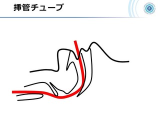 血ガス呼吸管理図スライド164.jpg