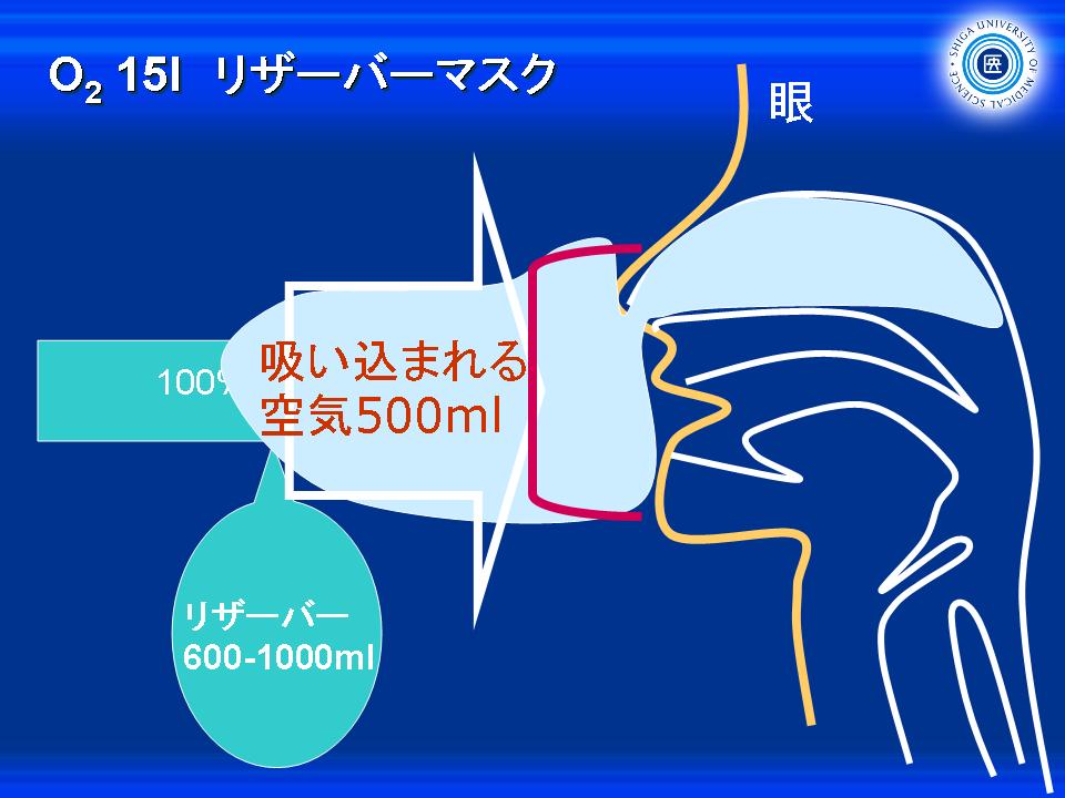 何気なく投与している酸素についてちゃんと考える９・リザーバーマスクの理屈: やさしイイ呼吸器教室