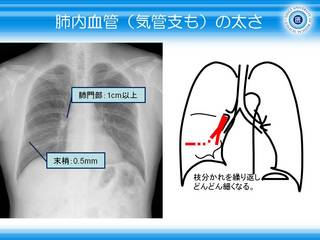 4肺内血管(気管支も)の太さ.jpg