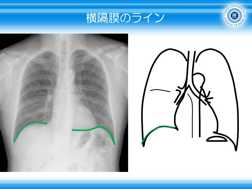 胸部X線・胸部レントゲン・胸部エコー 医学書３冊セット 胸部 X 線写真 : 左第 3 弓の突出(矢印)を認めた. | Download