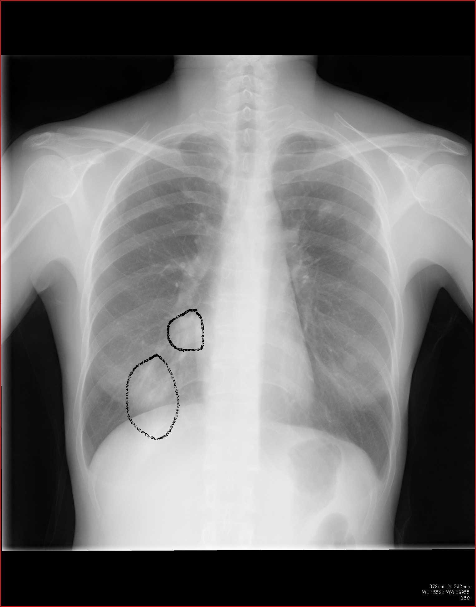 胸部レントゲン写真で、ここまでわかる・シルエット・サインを使う４の